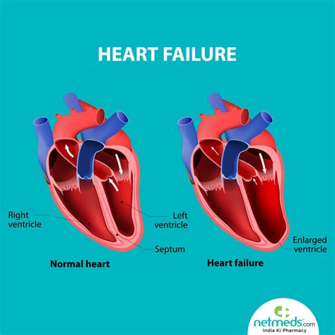 what is severe Lv impairment